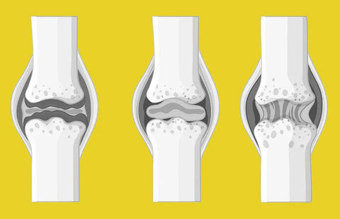 Quel CBD pour lutter contre l’arthrose ?