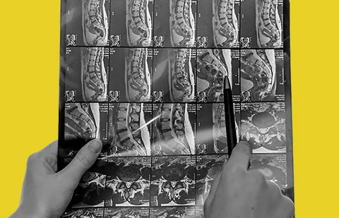 Welke CBD moet je kiezen om ischias te bestrijden? 